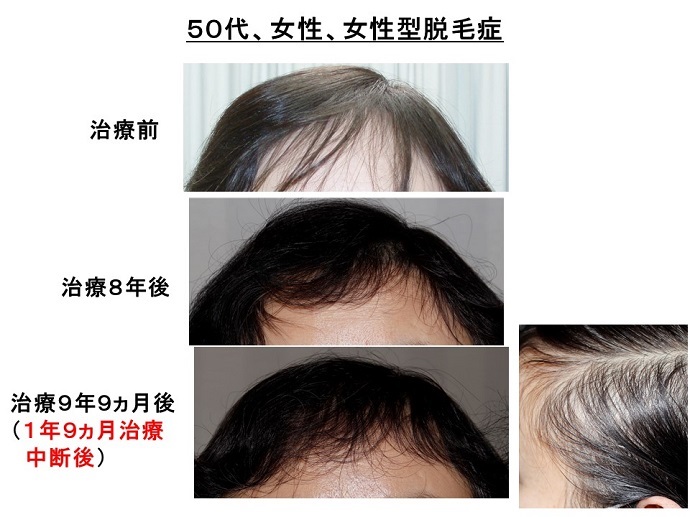円形脱毛症　病院